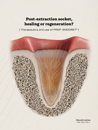Post-extraction socket, healing or regeneration? Therapeutics and use of PRGF-ENDORET®